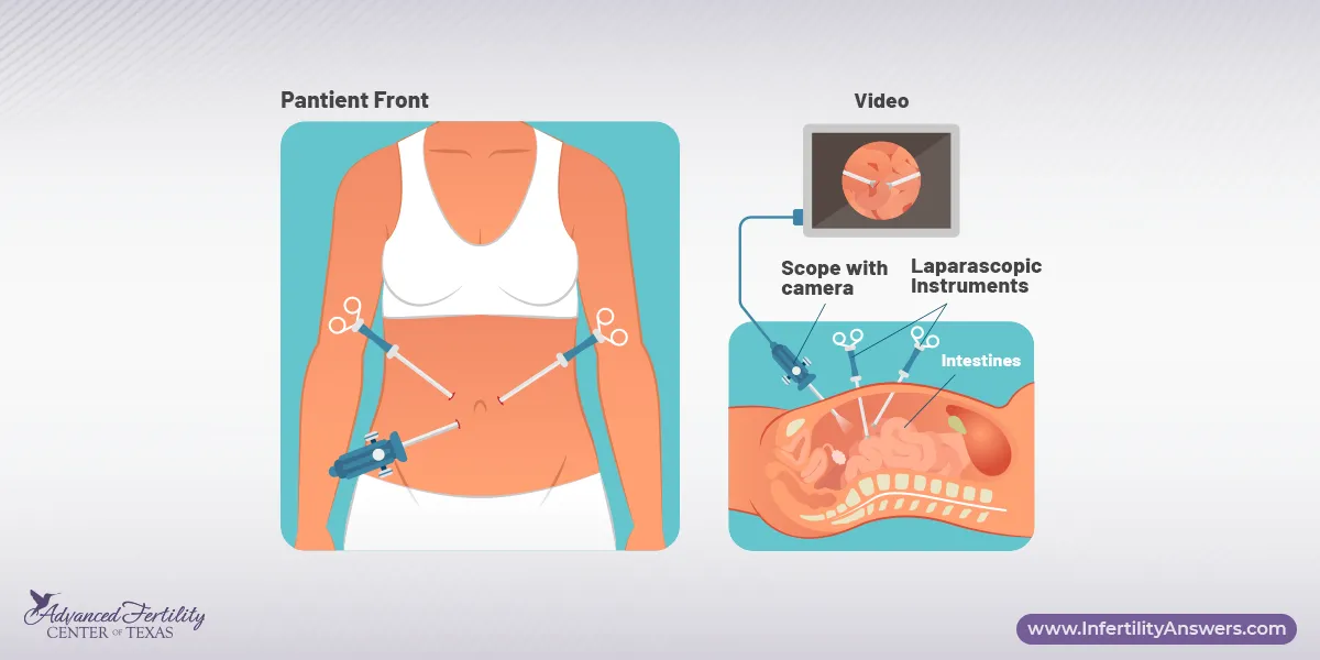 Female Pelvic Laparoscopy