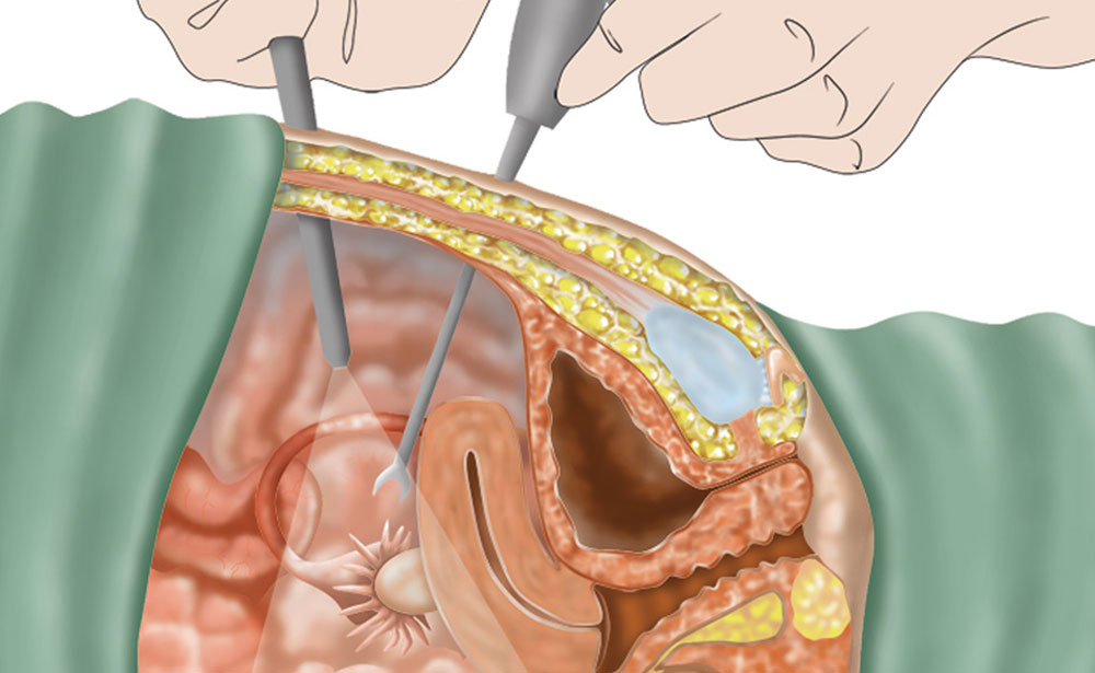 PCOS Surgery