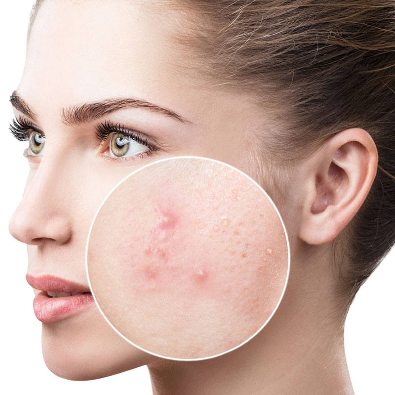Acne / Thinning Hair / Hirsutism